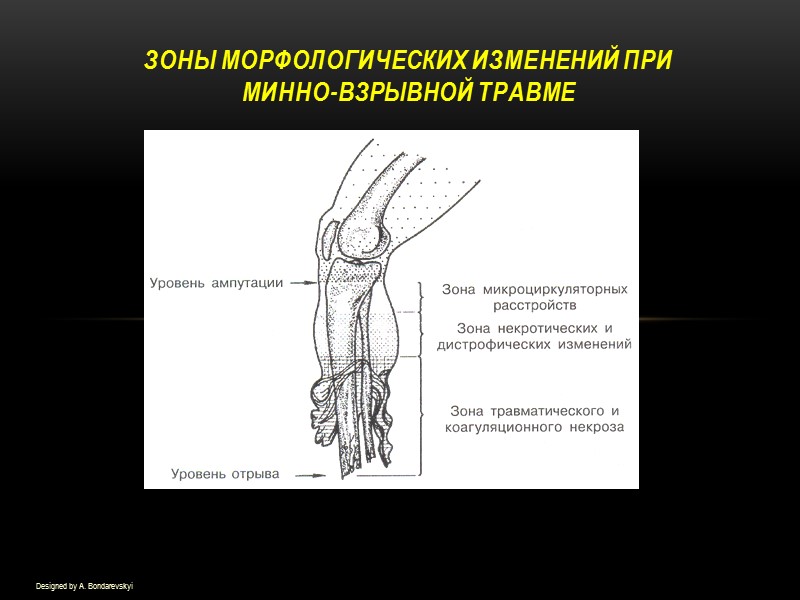 Зоны морфологических изменений при  минно-взрывной травме Designed by A. Bondarevskyi